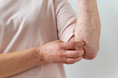 Hemp for Treating Skin Allergies: Eczema, Rashes, Acne & More
